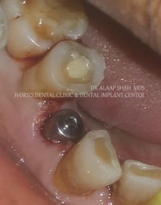 HEALING ABUTMENT   